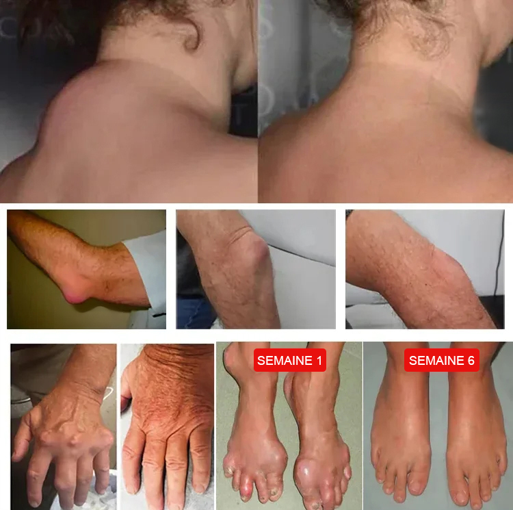 【Muscles relaxés, pénètre les os, soulagement rapide de la douleur】Plante à action profonde Miaojiang