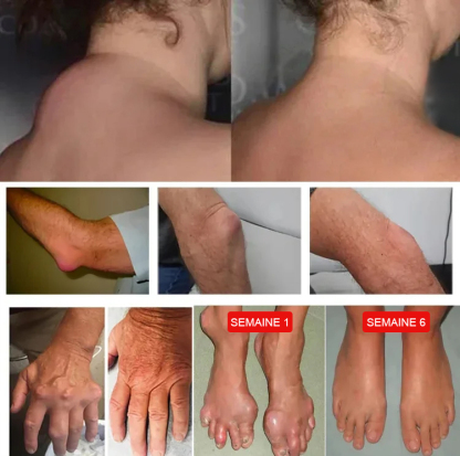 【Muscles relaxés, pénètre les os, soulagement rapide de la douleur】Plante à action profonde Miaojiang