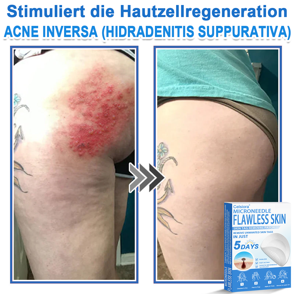 ⭐Celsiora® 2-in-1 Mikronadel- & Hydrokolloid-Pflaster | Entferner für erhabene Muttermale, Akne, flache Warzen & Hautanhängsel | Verbessert Falten, Narben & Hautunreinheiten | Unsichtbare Stern-Pickelpflaster für Gesicht & Körper