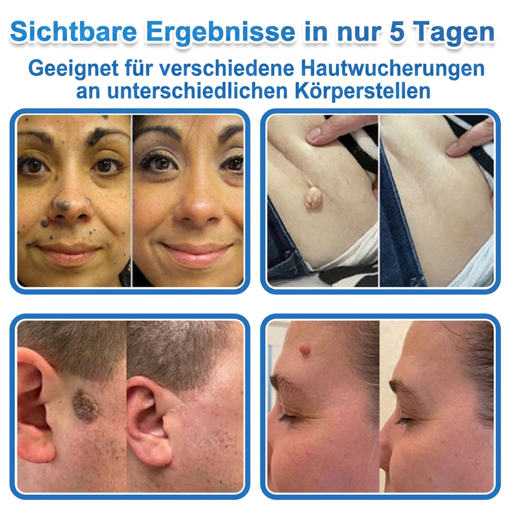 ⭐Celsiora® 2-in-1 Mikronadel- & Hydrokolloid-Pflaster | Entferner für erhabene Muttermale, Akne, flache Warzen & Hautanhängsel | Verbessert Falten, Narben & Hautunreinheiten | Unsichtbare Stern-Pickelpflaster für Gesicht & Körper