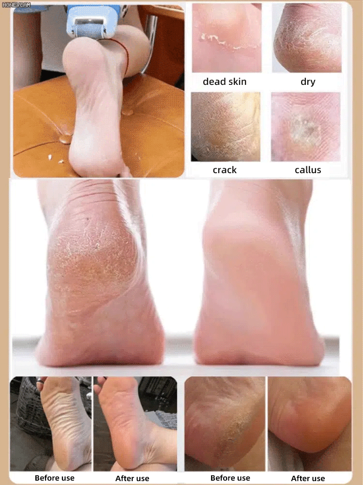 Buy 1 Get 1 Free! Buy 2 Get 2 Free! 🦶Electric foot scrubber✨👡 One-Touch Smoothing: Reclaim Baby-Soft Feet.