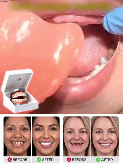 Kaufe 1 und erhalte 1 gratis!🔥 Kaufe 2 und erhalte 2 gratis!🔥Rabatte sind nicht jeden Tag verfügbar.🚨Natürlich wie echte Zähne: Die diskrete Lösung für Ihr schönstes Lächeln 😊🌟