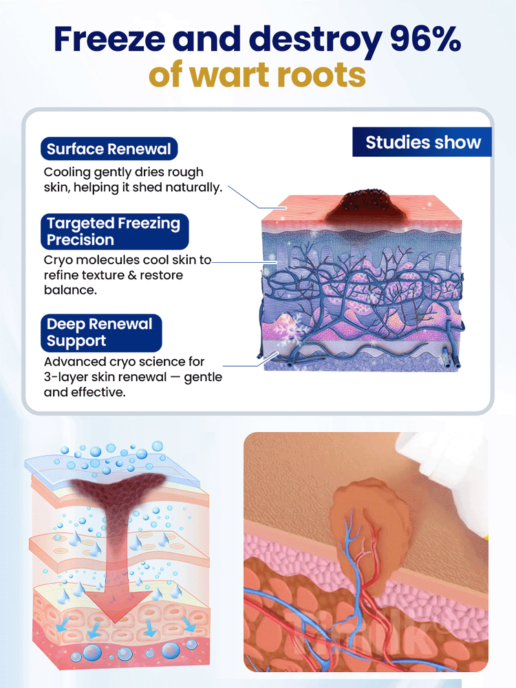【👨‍⚕️✅Von Dermatologen empfohlen】🌟Kryotherapie-Warzenentfernungsspray aus den USA👍Schmerzfrei, narbenfrei, reizt die Haut nicht und wirkt dauerhaft💯100 % natürliche Formel, geeignet für alle Hauttypen, fördert die Hautregeneration