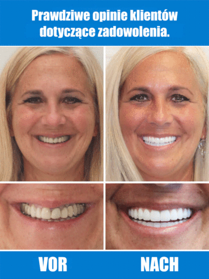 【FDA&BDA podwójna certyfikacja】Samokształtujące się protezy zębowe