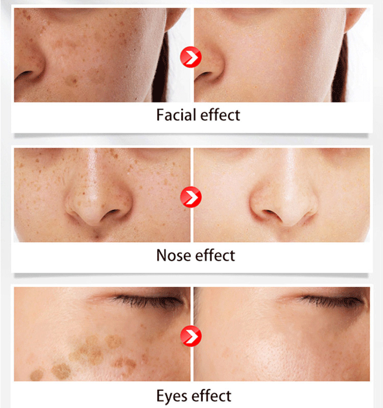 Whitening Anti-Freckle Moisturizing Cream