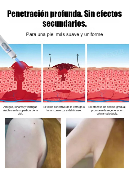 Lápiz láser para eliminar verrugas sin dolor