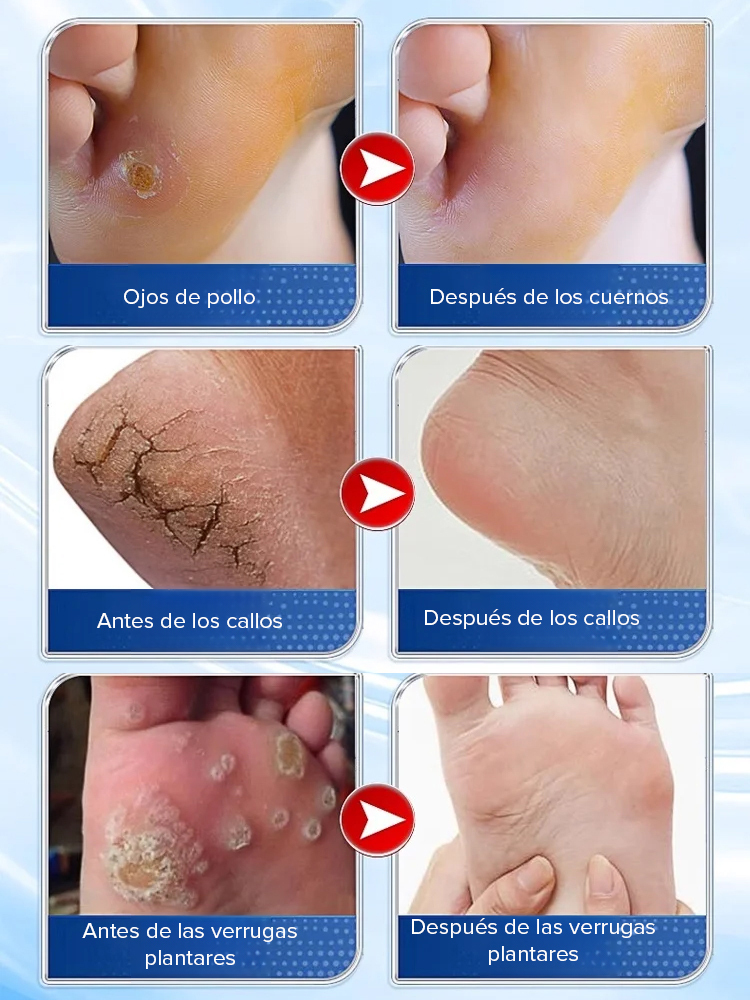 Crema herbal para eliminar callos de pollo sin dolor en 7 días.