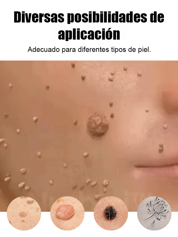 Lápiz láser para eliminar verrugas sin dolor