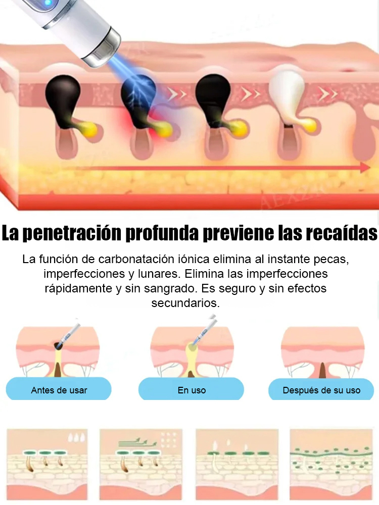 Lápiz láser para eliminar verrugas sin dolor