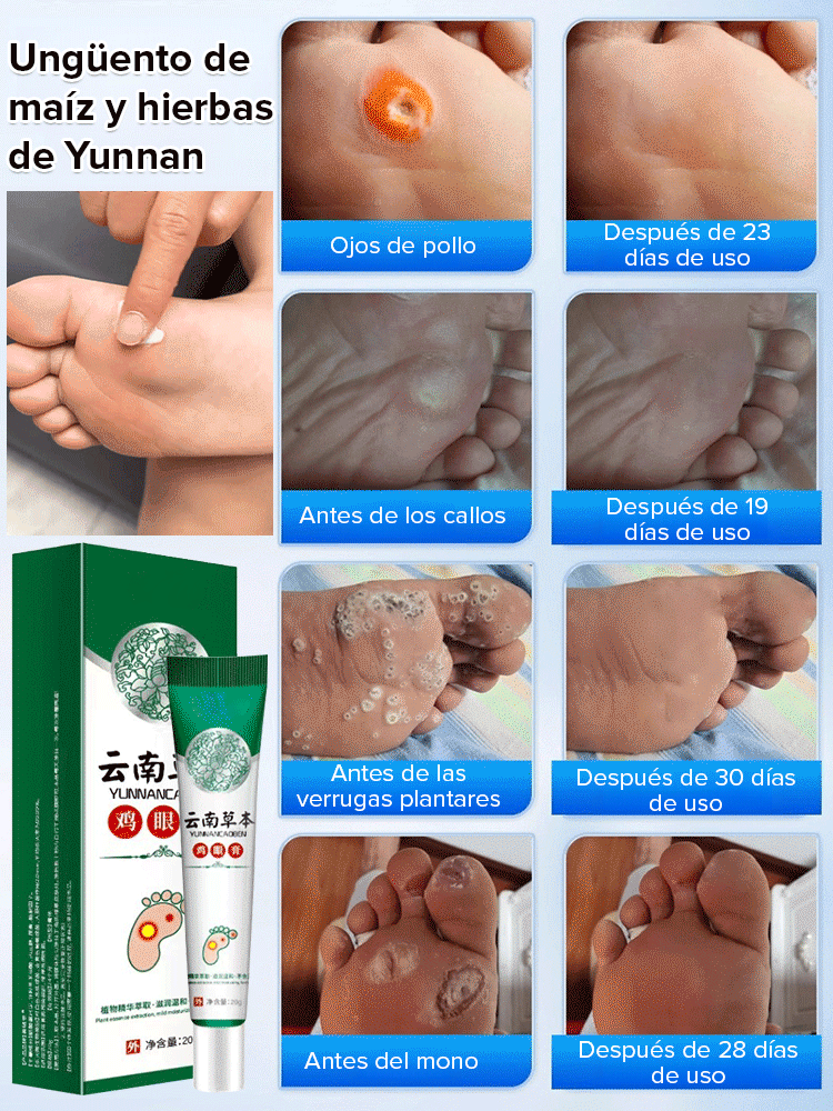 Crema herbal para eliminar callos de pollo sin dolor en 7 días.