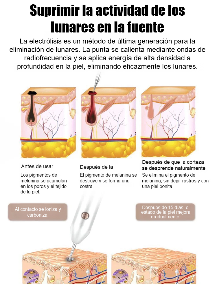 Lápiz láser para eliminar verrugas sin dolor