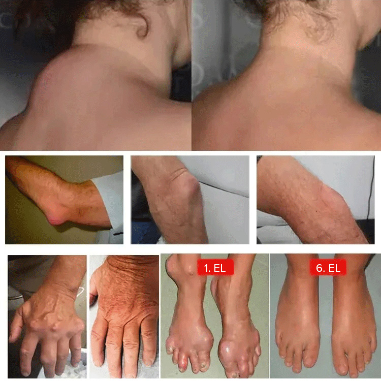 Aceite de hueso dorado de cinco venenos de hueso de serpiente