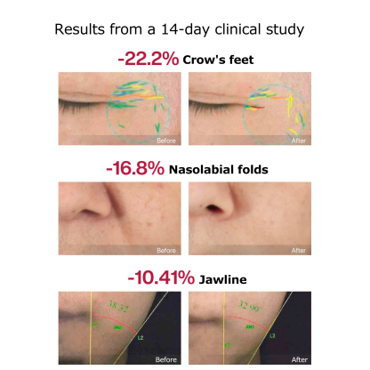 Vellera™ S1 Pro Facial Skin Tightening Device