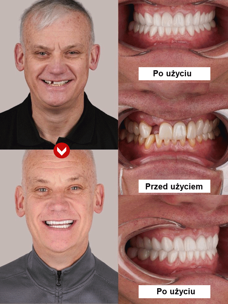 【Odzyskaj perfekcyjny uśmiech】Mocno przylegające medyczne pełne protezy zębowe