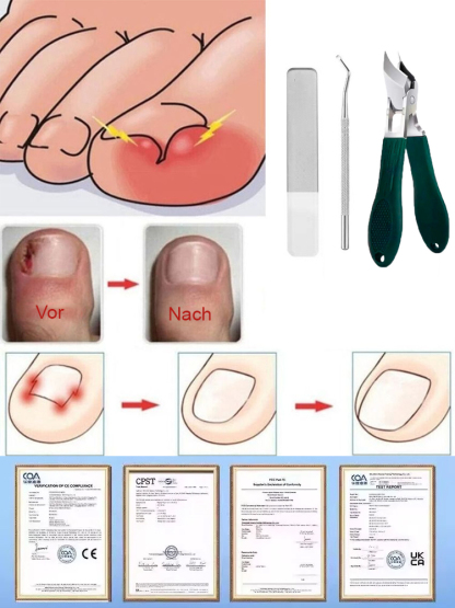 Spezial-Nagelknipser-Set für Paronychie✂️✂️ Die Komplettlösung gegen wiederkehrende Entzündungen: Professionelle Maniküre-Pflege für Ihre Hausapotheke.