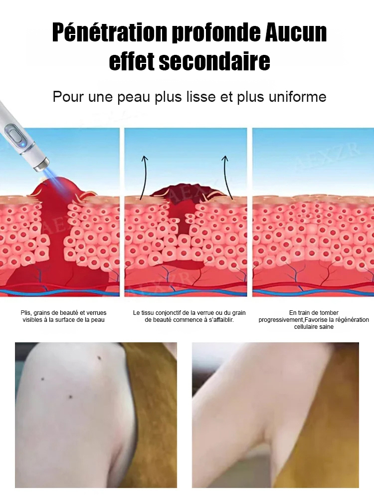 Stylo laser pour éliminer les verrues sans douleur✨️Dites adieu aux verrues sans douleur, pour une peau lisse et éclatante !