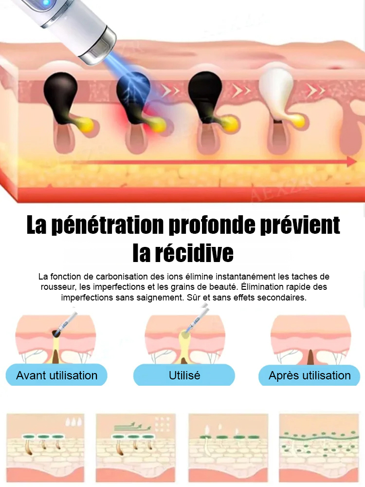 Stylo laser pour éliminer les verrues sans douleur✨️Dites adieu aux verrues sans douleur, pour une peau lisse et éclatante !