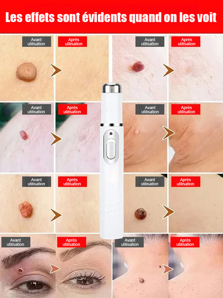 Stylo laser pour éliminer les verrues sans douleur✨️Dites adieu aux verrues sans douleur, pour une peau lisse et éclatante !