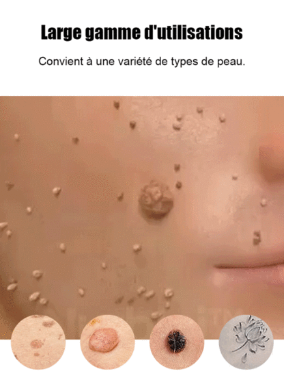 Stylo laser pour éliminer les verrues sans douleur✨️Dites adieu aux verrues sans douleur, pour une peau lisse et éclatante !