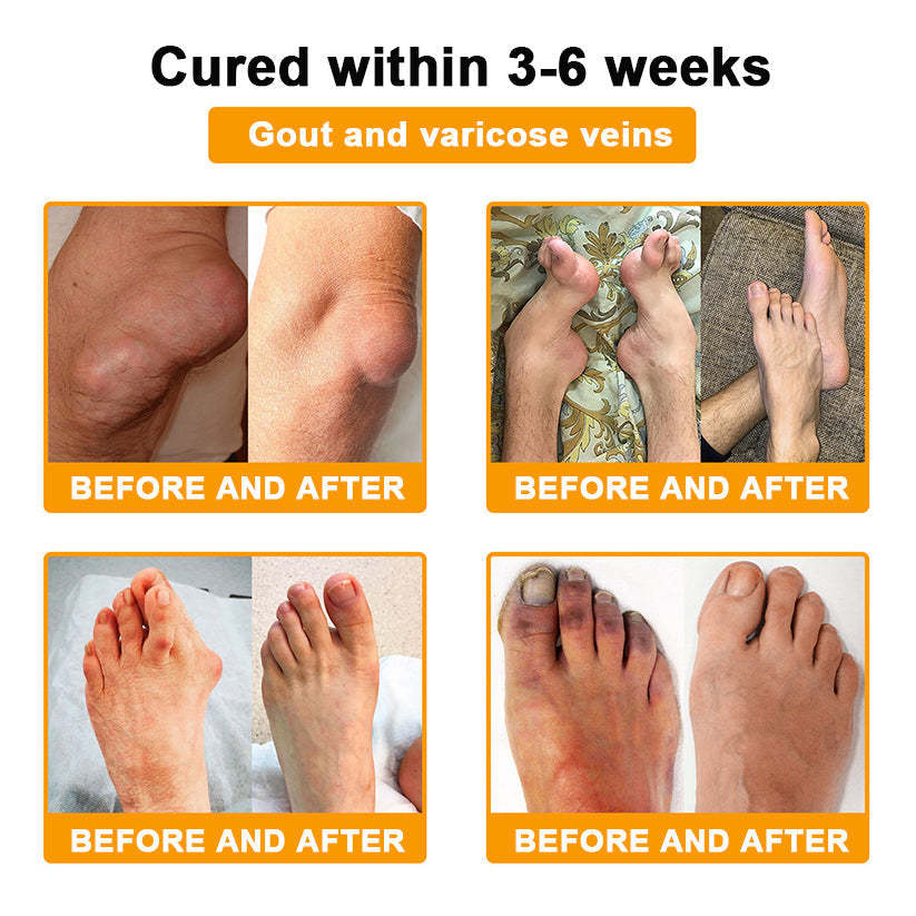 🐝ODALIT™ Botulinum Toxin & Bee Venom Pain-Relief Bone Healing Cream 🐝💎