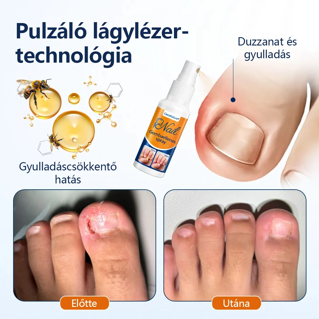 CleraNature® körömgomba-könnyítő spray  🎉 180 napos pénzvisszafizetési garancia – próbáld ki kockázat nélkül.