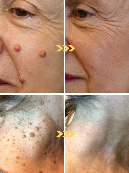 Anti-Verrue Spray – Rafraîchissant & Sans Douleur