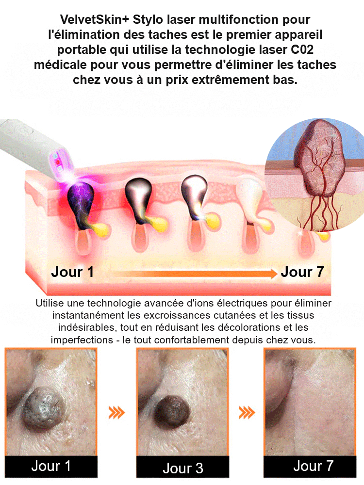  Stylo de soin cutané à laser doux pour enlever les grains de beauté et les verrues
