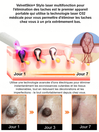  Stylo de soin cutané à laser doux pour enlever les grains de beauté et les verrues