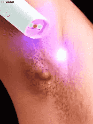  Stylo de soin cutané à laser doux pour enlever les grains de beauté et les verrues