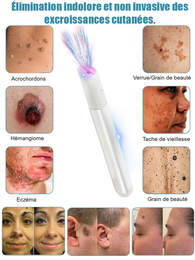  Stylo de soin cutané à laser doux pour enlever les grains de beauté et les verrues