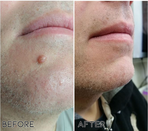 ✅✅Medazy™ Bee Lixir Wart Remover Ointment