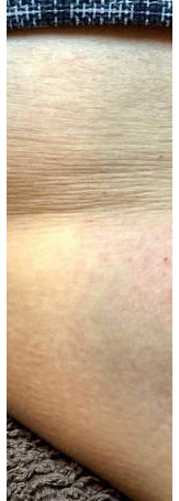 ✅✅Medazy™ Bee Lixir Wart Remover Ointment