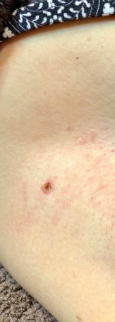 ✅✅Medazy™ Bee Lixir Wart Remover Ointment