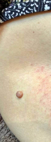 ✅✅Medazy™ Bee Lixir Wart Remover Ointment