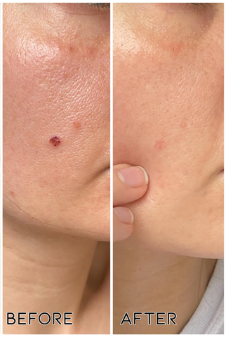 ✅✅Medazy™ Bee Lixir Wart Remover Ointment