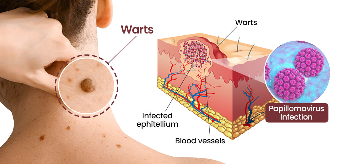 Laozik®KeraErase Dual-Action Renewal Cream