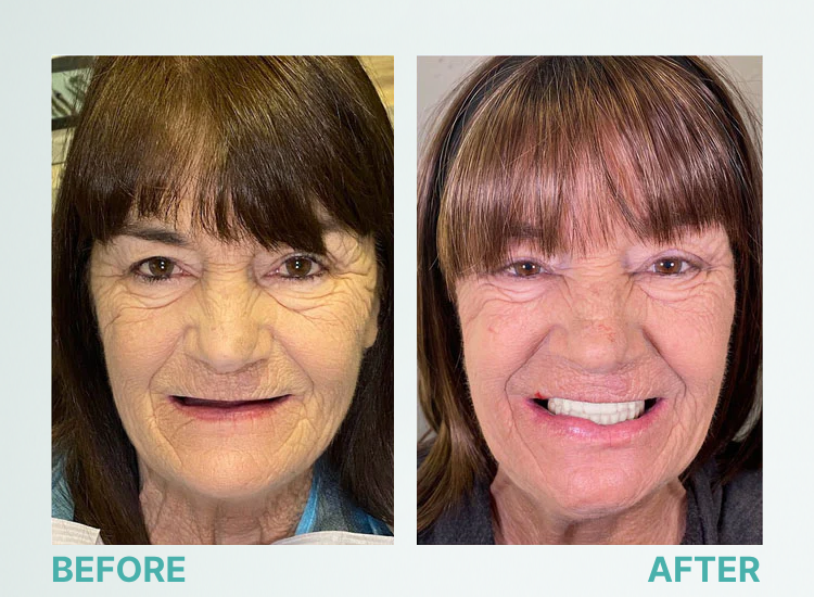 ROSOPL™ Custom-Fit Full Functional Dentures image ROSOPL™ Custom-Fit Full Functional Dentures