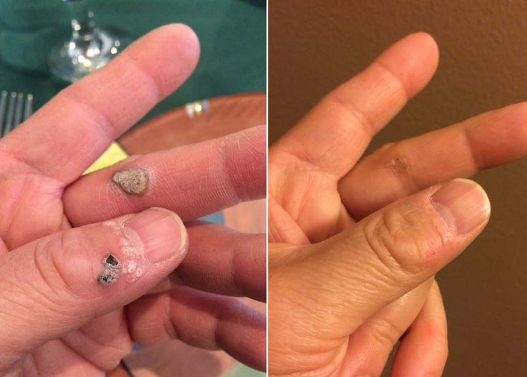 Laozik®KeraErase Dual-Action Renewal Cream