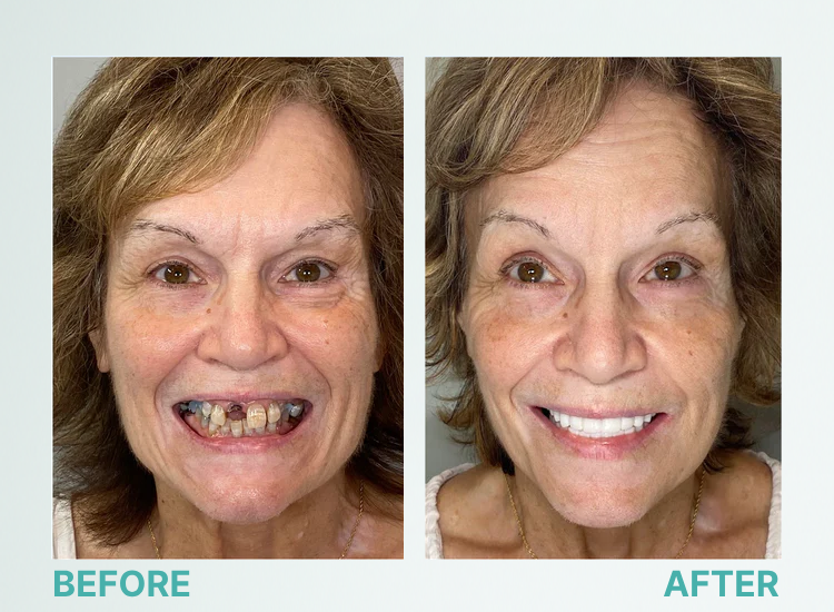 ROSOPL™ Custom-Fit Full Functional Dentures image ROSOPL™ Custom-Fit Full Functional Dentures