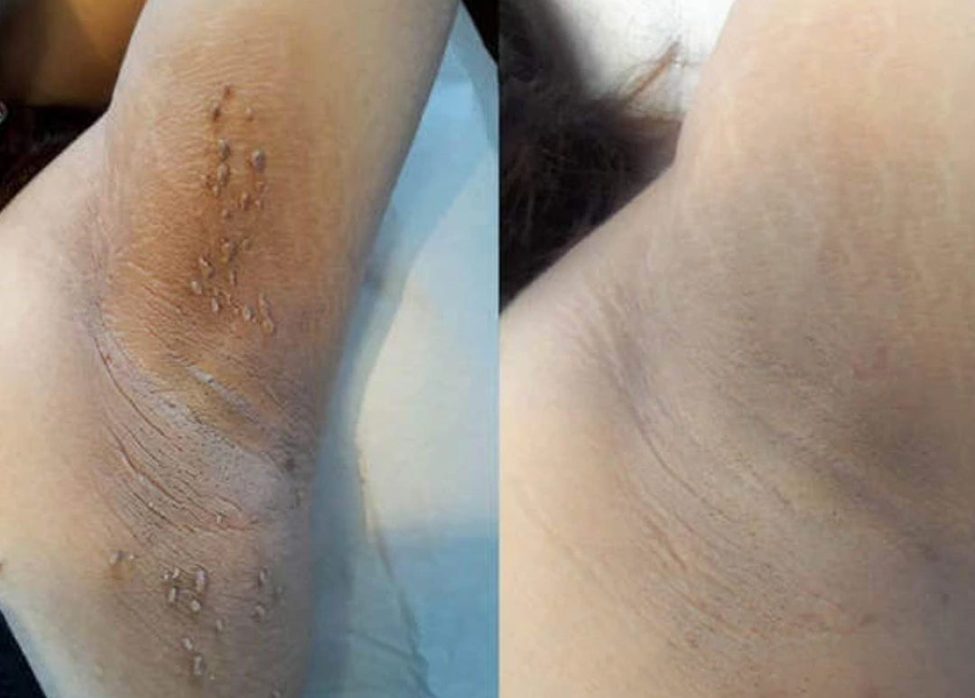 Laozik®KeraErase Dual-Action Renewal Cream