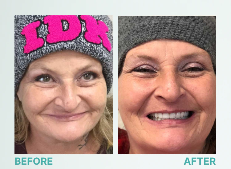 ROSOPL™ Custom-Fit Full Functional Dentures image ROSOPL™ Custom-Fit Full Functional Dentures