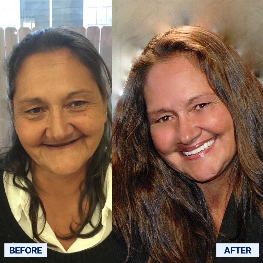 ROSOPL™ Custom-Fit Full Functional Dentures image ROSOPL™ Custom-Fit Full Functional Dentures