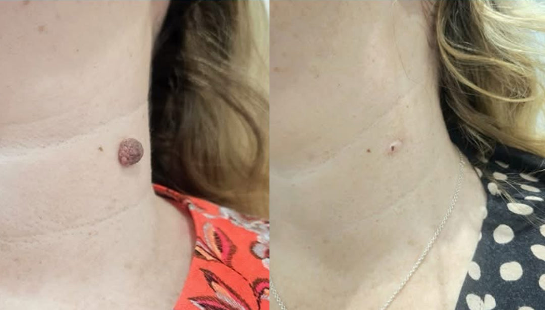 Laozik®KeraErase Dual-Action Renewal Cream