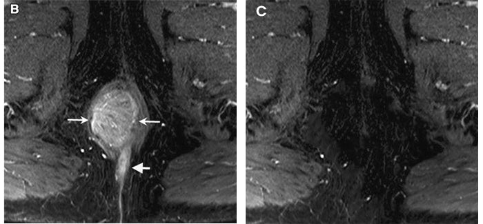ROSOPL® Fast-Acting Herbal Hemorrhoid Spray Pro