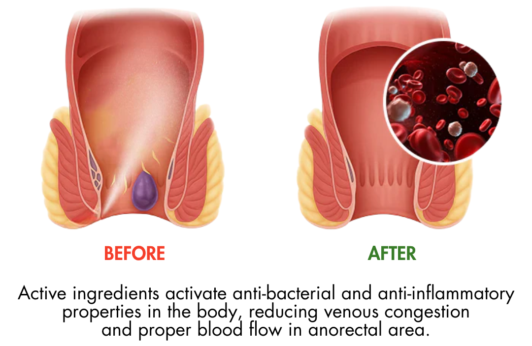 ROSOPL® Fast-Acting Herbal Hemorrhoid Spray Pro