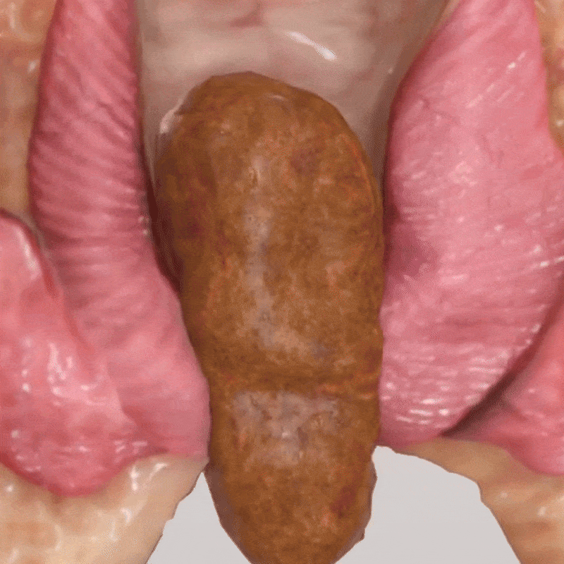 ROSOPL® Fast-Acting Herbal Hemorrhoid Spray Pro