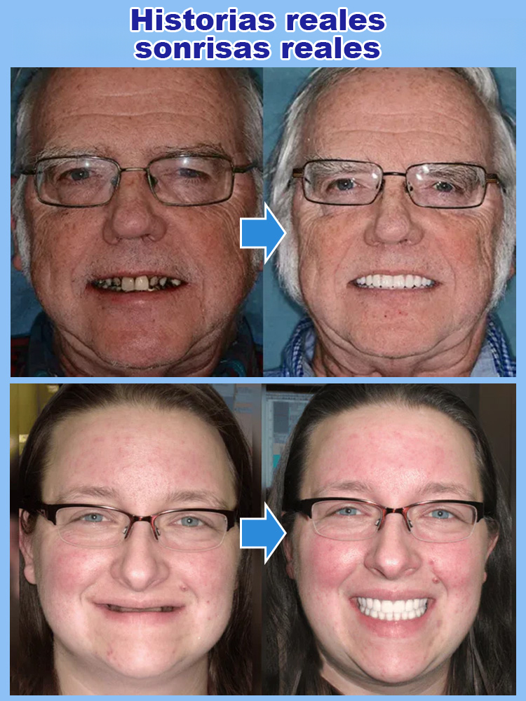 🚀 ¡Sin pegamento, sin dentista, sin espera! Prótesis Dental de Sonrisa Perfecta, instalación en 1 segundo🦷