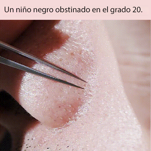 pinzas para eliminar la espinilla del acné.Elimina los puntos negros rebeldes en 3 segundos