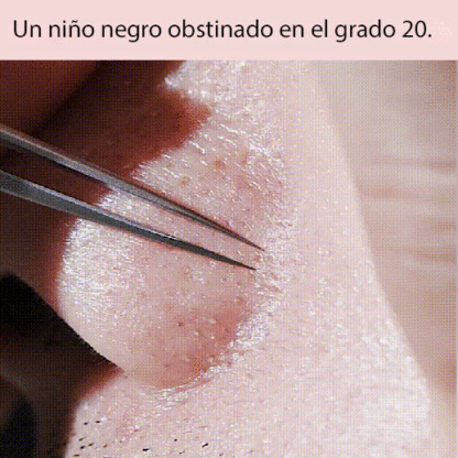 pinzas para eliminar la espinilla del acné.Elimina los puntos negros rebeldes en 3 segundos