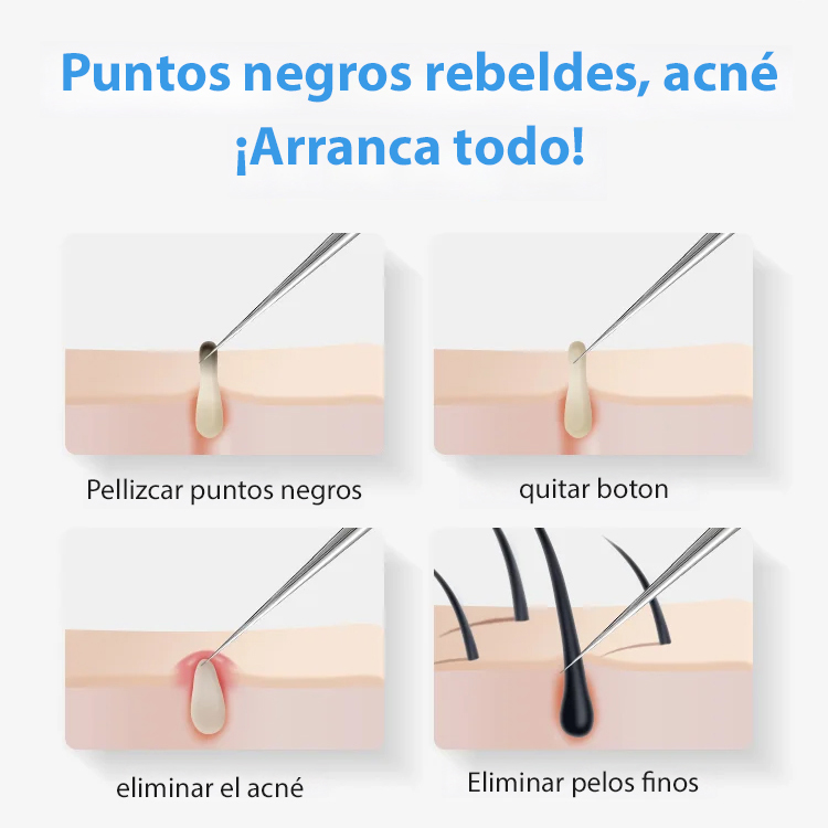 pinzas para eliminar la espinilla del acné.Elimina los puntos negros rebeldes en 3 segundos